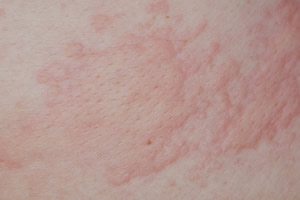 蕁麻疹の皮膚の状態